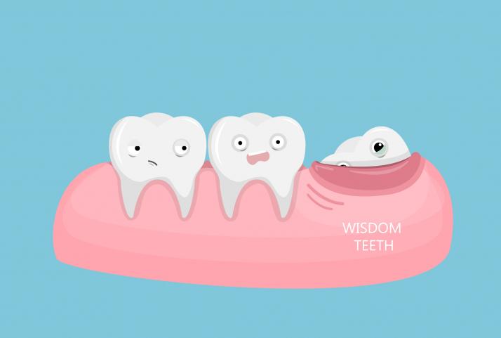 Wisdom teeth